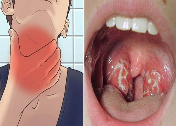 Là một dạng bệnh viêm nhiễm trùng phổ biến gây đau cổ họng