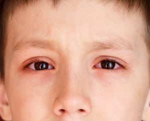 Bệnh đau mắt đỏ rất nguy hiểm khi bị ở trẻ em