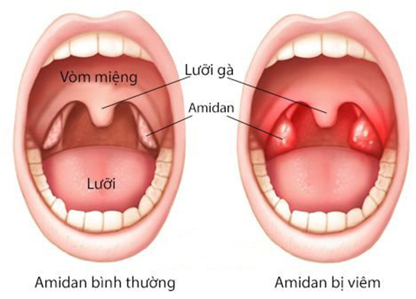 Viêm amidan là tình trạng amidan bị nhiễm trùng, sưng, đau