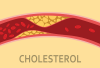 Mách bạn 5 cách giảm cholesterol trong máu hiệu quả