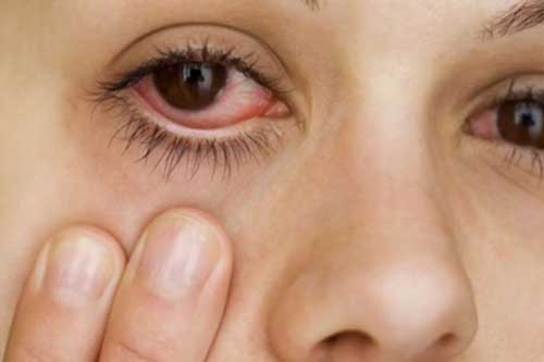 Viêm thấp khớp có thể gây tổn thương đến đôi mắt