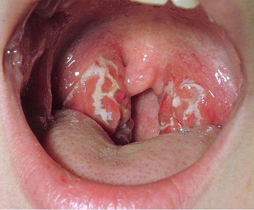 Nhận biết ung thư vòm họng