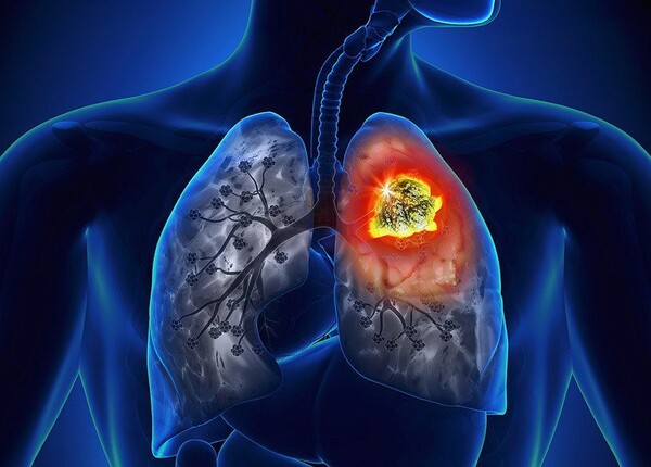 Ung thư phổi các triệu chứng và cách xác định chuẩn đoán